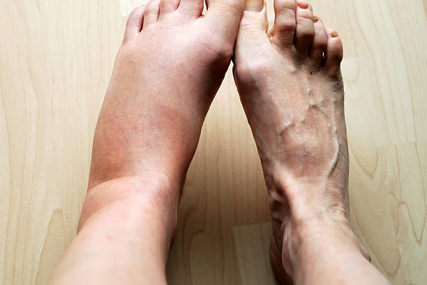 Cara Mengatasi Kaki Bengkak Tips Ampuh untuk Meredakan Kaki Bengkak
